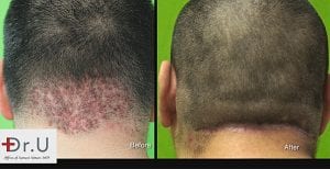 Back of Head Bumps Surgically Cured By Dr U - Before and after photo