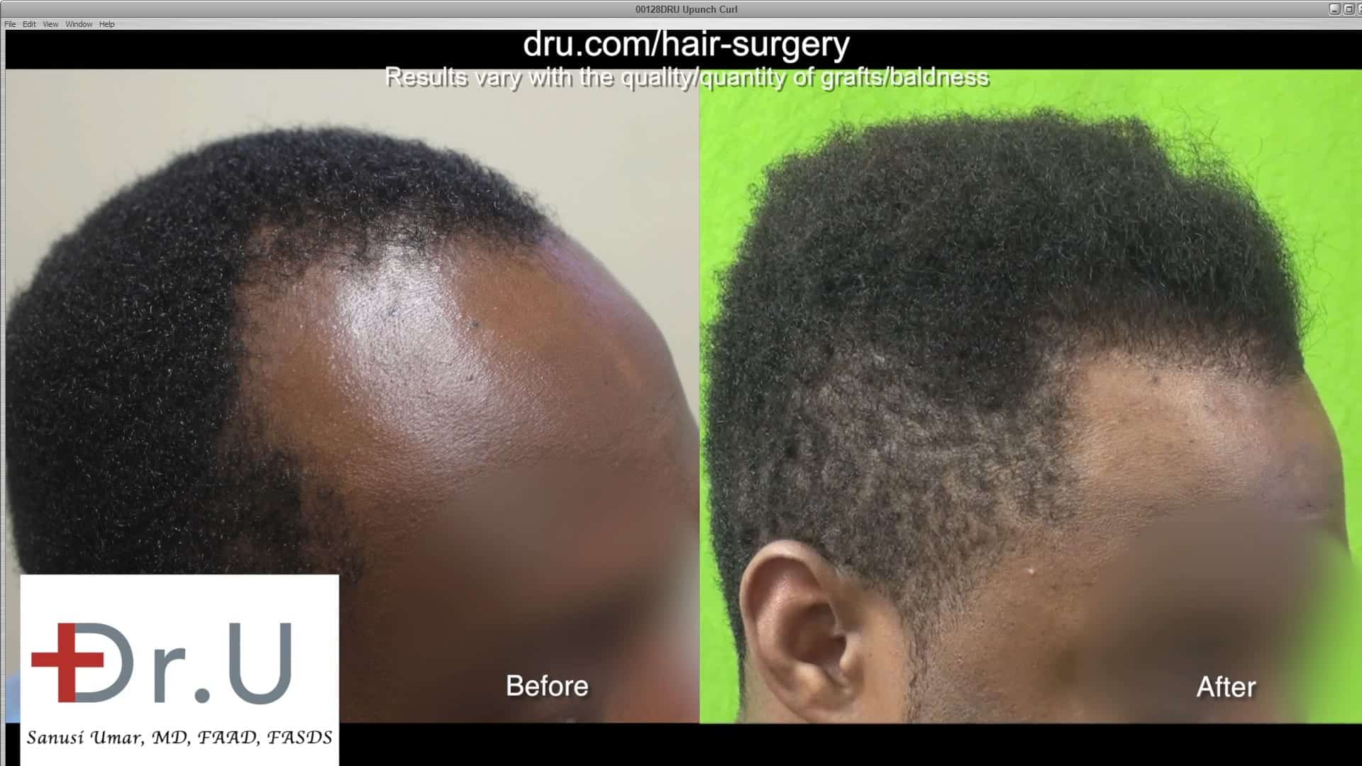Video - Linear Scar Free Black Hair Restoration For All African Hair