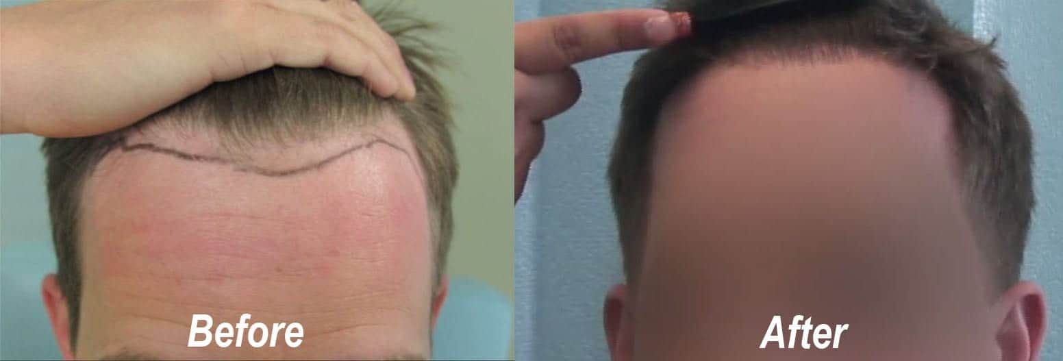 Video Dr U Graft Receding Hairline Restoration Hair Transplant Using 1850 Ugrafts Thumb47 Before And After 