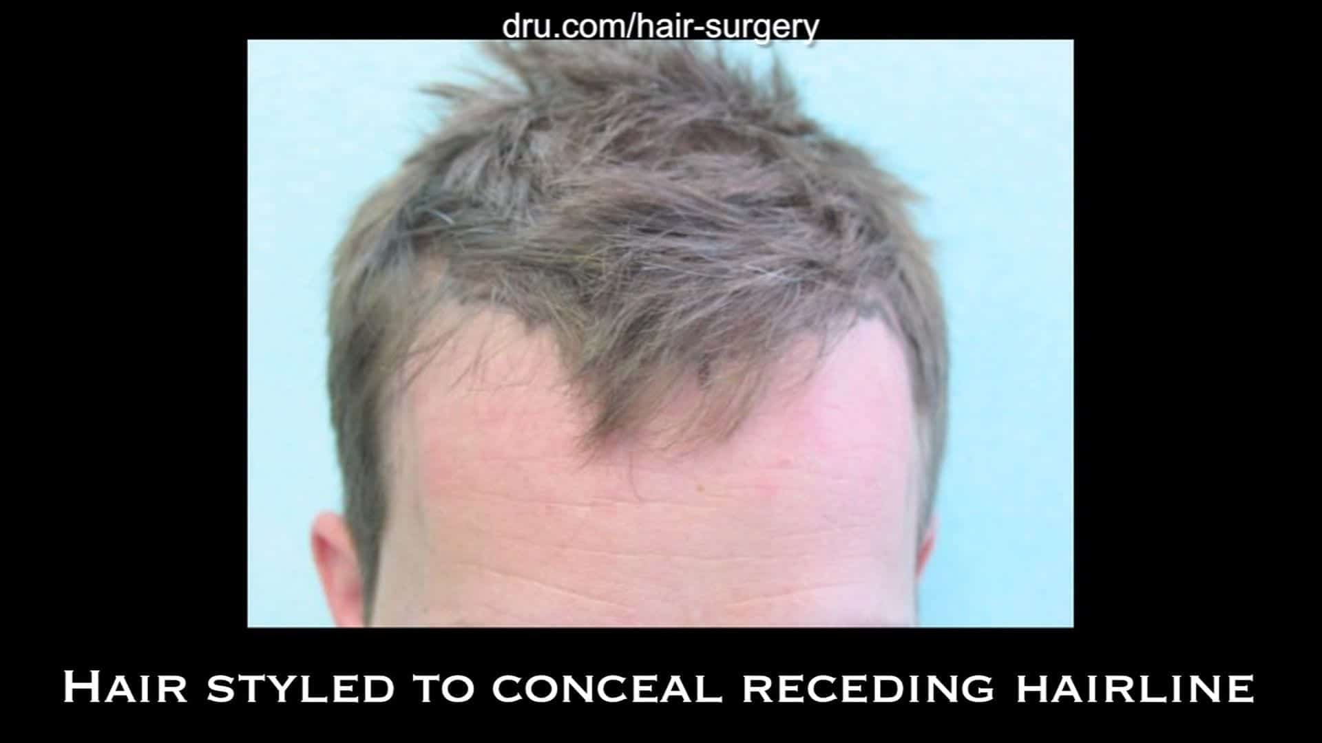 Video: Receding Hairline Hair Transplant Using 1850 UGrafts