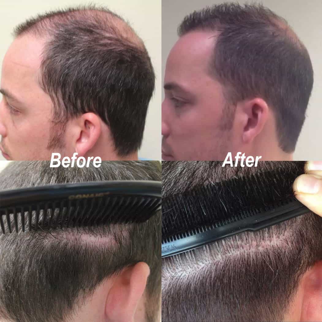 Dr UGraft FUE Hair Transplant Using 1600 Head Grafts For Strip Scar Restoration - Before and After