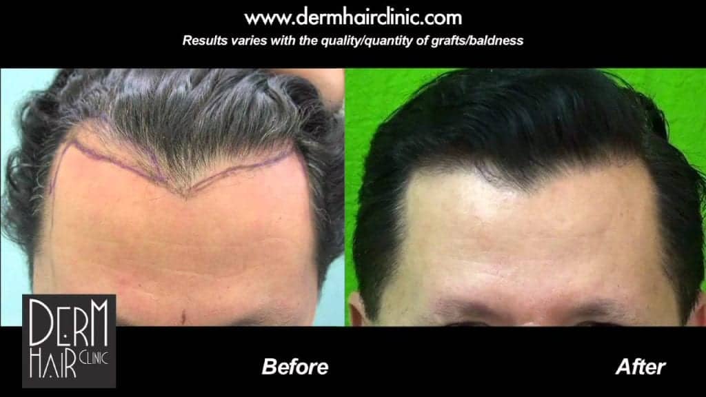 Graft count influencing cost of hair restoration: This Dr U patient with minor frontal hair loss needed only 600 grafts to meet his needs Graft count influencing cost of hair restoration: This Dr U patient with minor frontal hair loss needed only 600 grafts to meet his needs