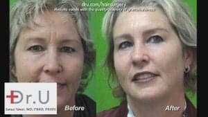 This woman is showing off her fuller and thicker eyebrows after Dr. U's eyebrow transplant surgery.