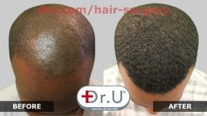 This patient had scarring in the front of his head from a childhood condition. Dr. Umar and his patented DrUPunch Curl gave this patient the hairline he always wanted.*