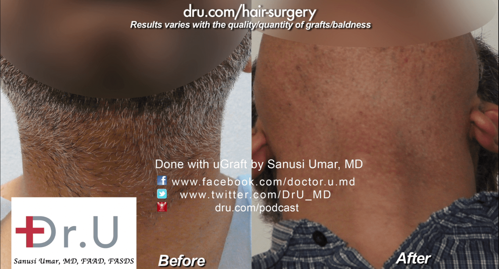 Dr. Umar used 4000 beard grafts for this procedure.*