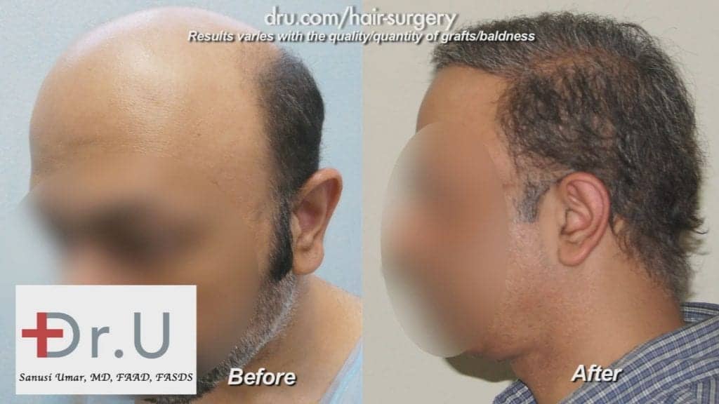 The NW7 Hair Transplant used grafts from the head and beard