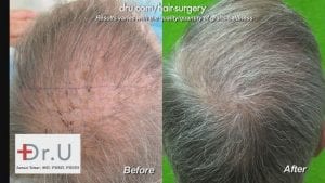 A drastic change can be seen by these before and after photos of a hair transplant patient of Dr. Umar.