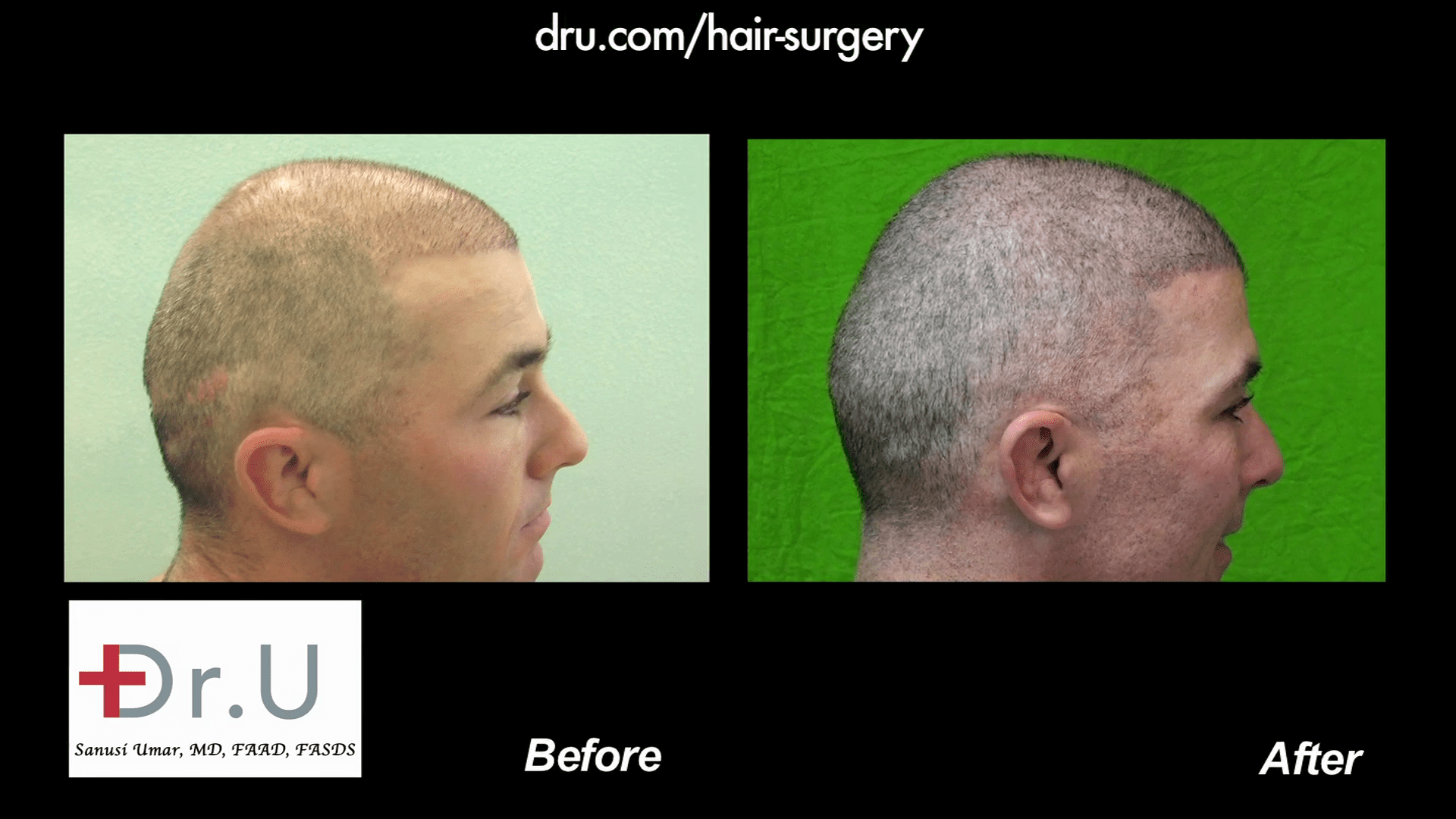 Video: Body Hair Transplantation Restores NW6 Thinning for a Buzz Cut