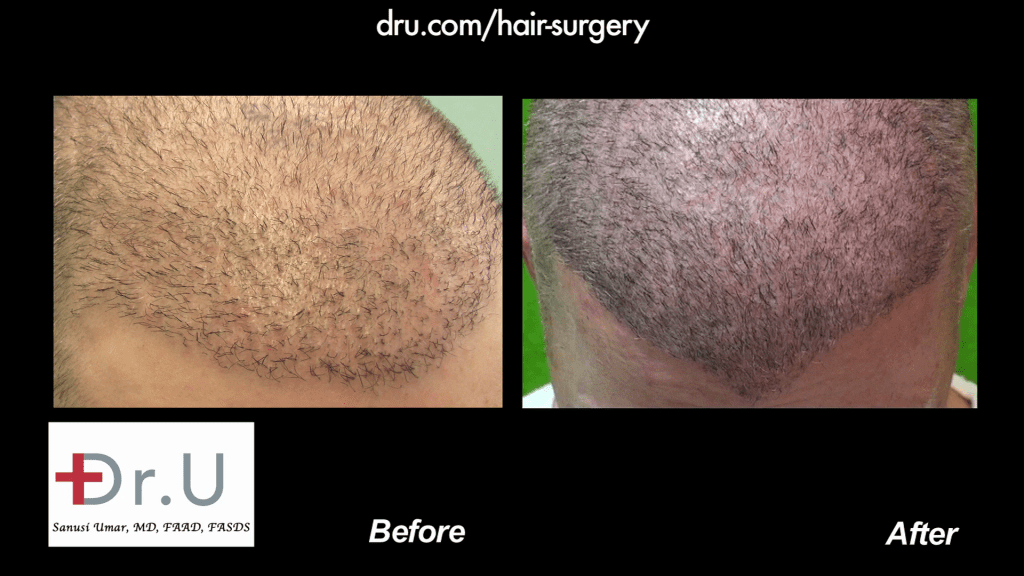 Body Hair Transplantation Restores Thinning Hairline in Males: Before and After DrUGraft