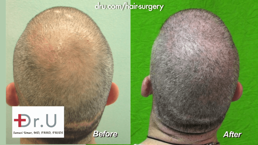 Dr UGraft Body Hair Transplantation Restores NW6 Thinning to NW 0 For A Buzz Cut before and after 13,500 Grafts