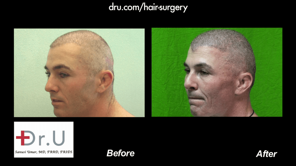 Before and after body hair transplantation restores thinning NW 6 For a Buzz Cut