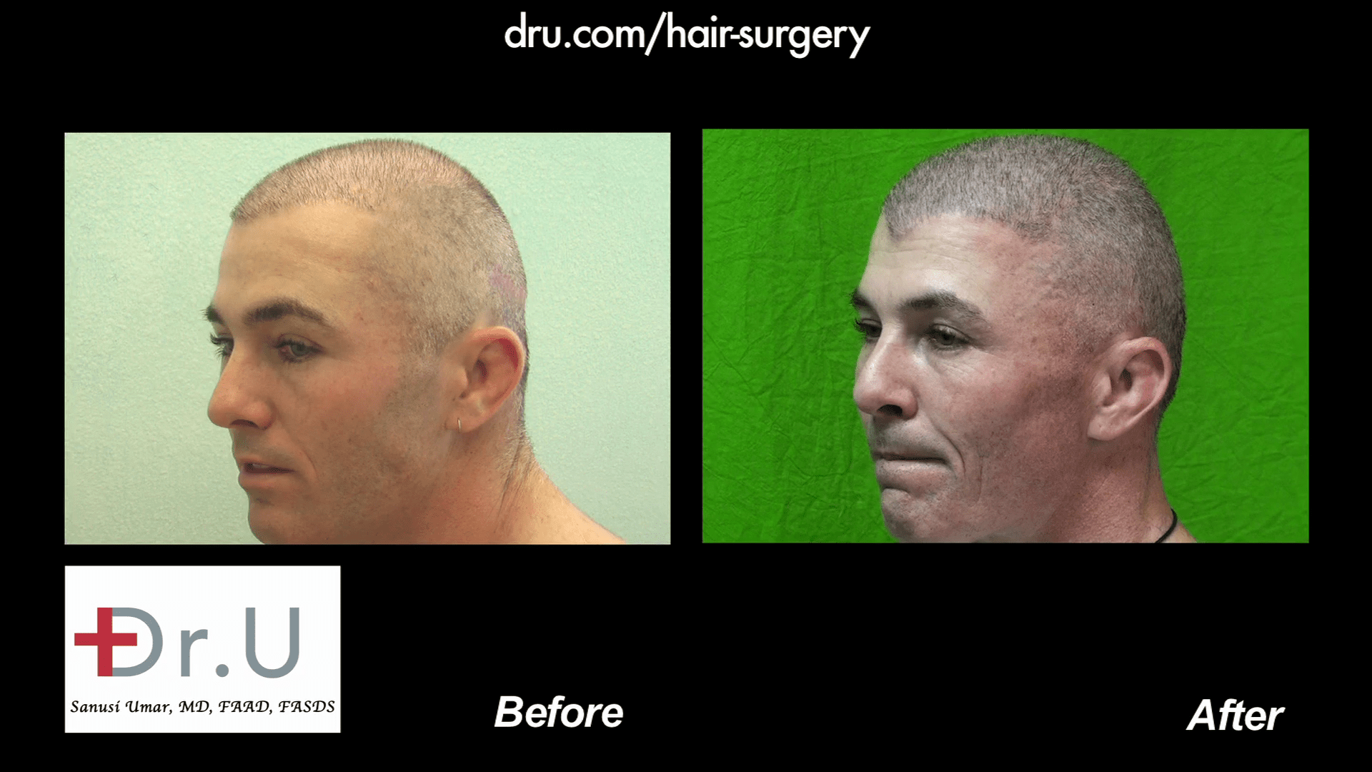 How long does a hair transplant surgery take Is hair transplantation  painful  Hairneva
