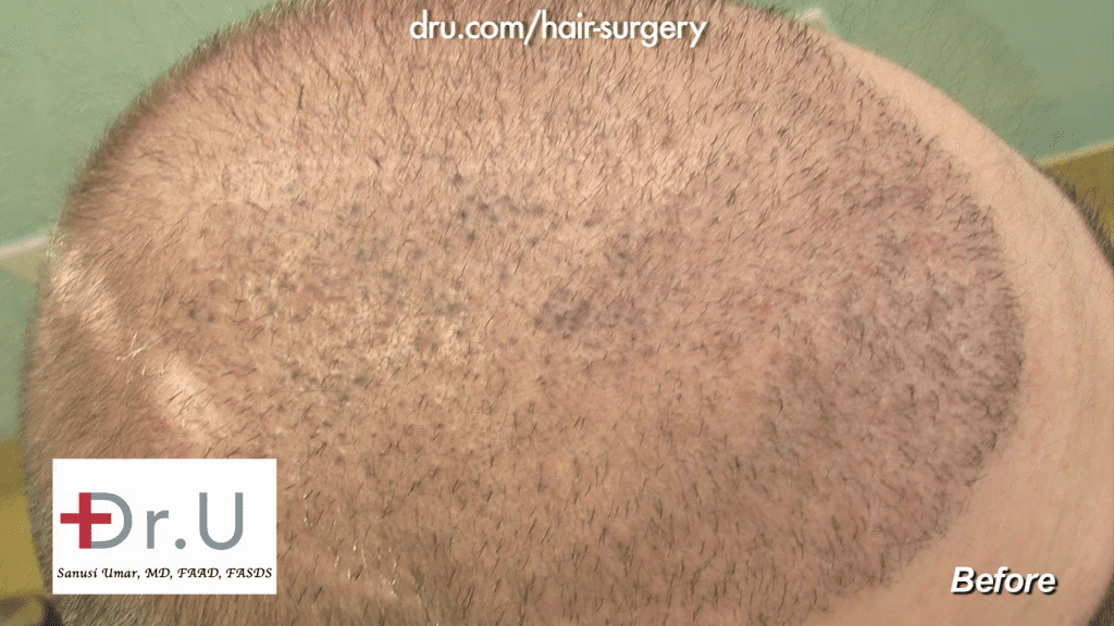 Top of patient's head depicting NW6 Baldness (eventually corrected with 13,500 DrUGrafts)