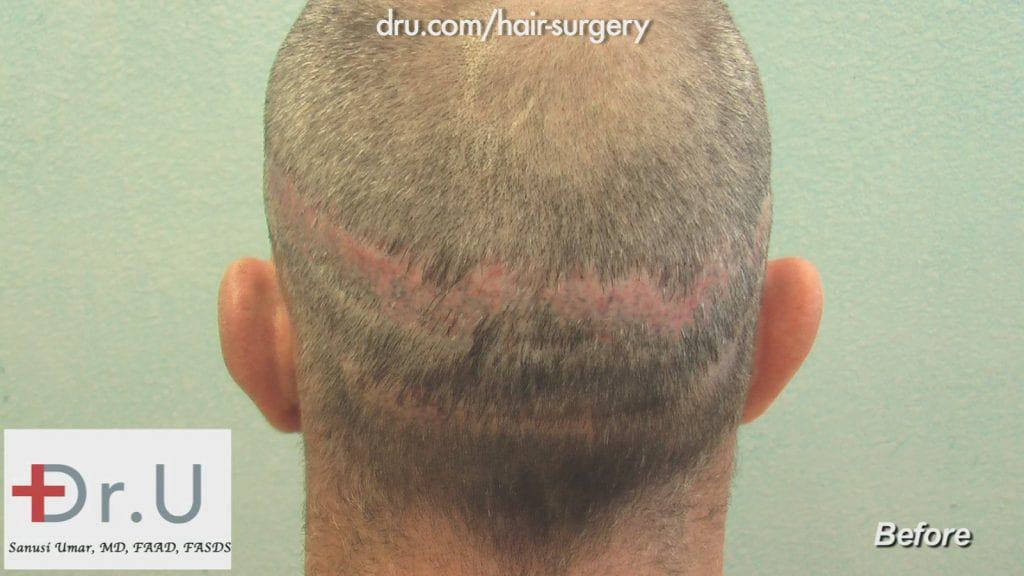 Video - Hair Transplant Scar Revision Before and After Dr.UGraft