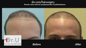 Dr. U in Los Angeles created a lower and fuller hairline for this patient.