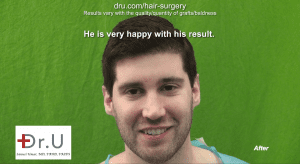 Video: Hairline Advancement Reduces Forehead Size Using 3200 Grafts