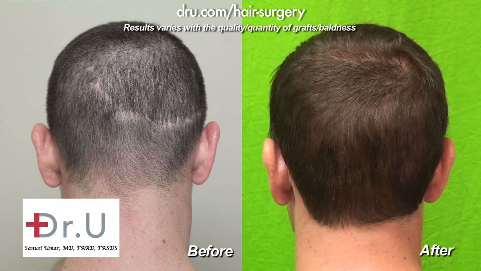 Video: Dr U Strip Surgery Advanced FUE Hair Transplant Repair Using 1500 Dr UGrafts