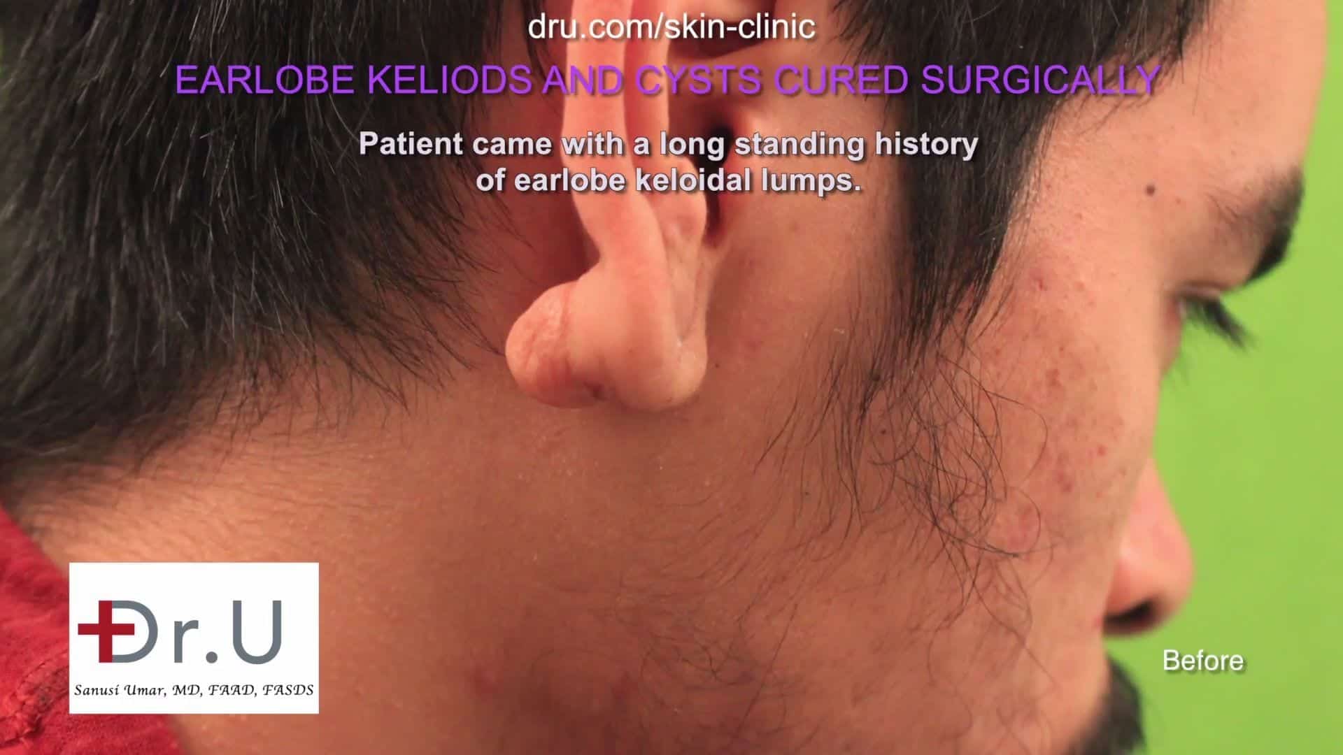 painful cyst behind ear