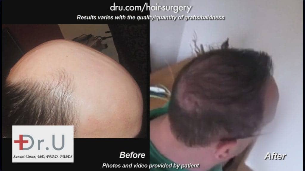 Video - Severely Bald Norwood 7 Patient Cured With  BHT