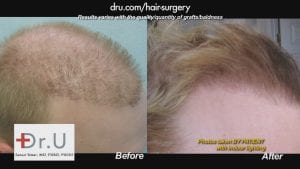 Before and after hairline photo of a patient who received a hair transplant from Dr. U in Los Angeles.