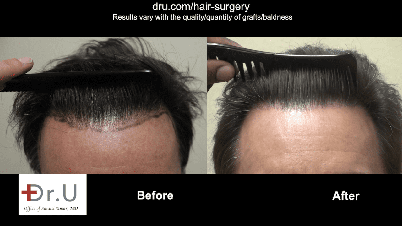 Video:  Hair Transplant With a Natural Hairline | Dr. U Hair Clinic