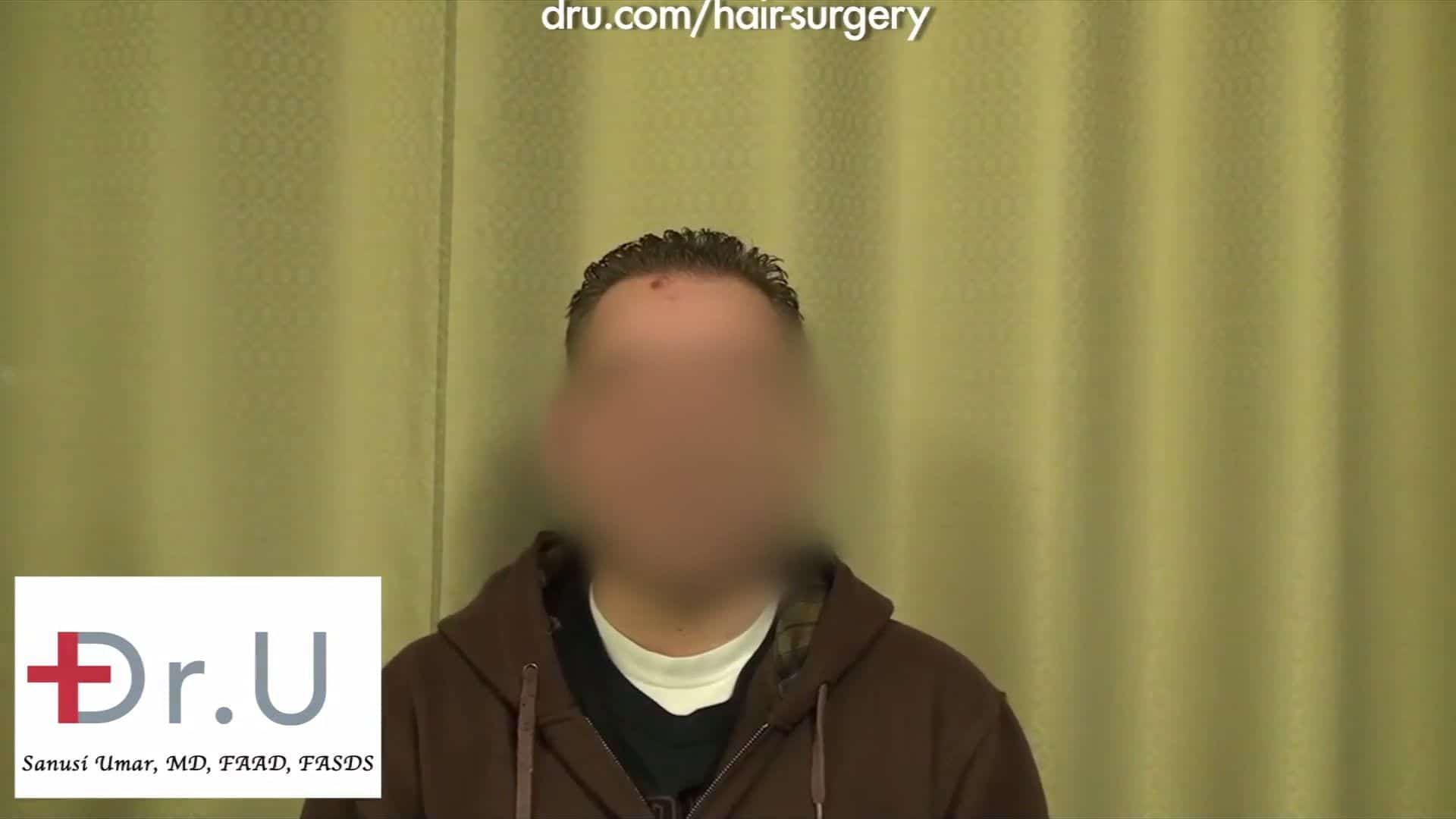 https://dru.com/wp-content/uploads/2017/05/Hs-045-Ugraft-Fue-Hair-Transplant-Using-3500-Grafts-For-Level-5-Thinning-1_thumb12.jpg