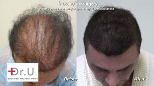 Dr. Umar, located in Los Angeles, was able to create the coverage this patient desired using his BHT technology.