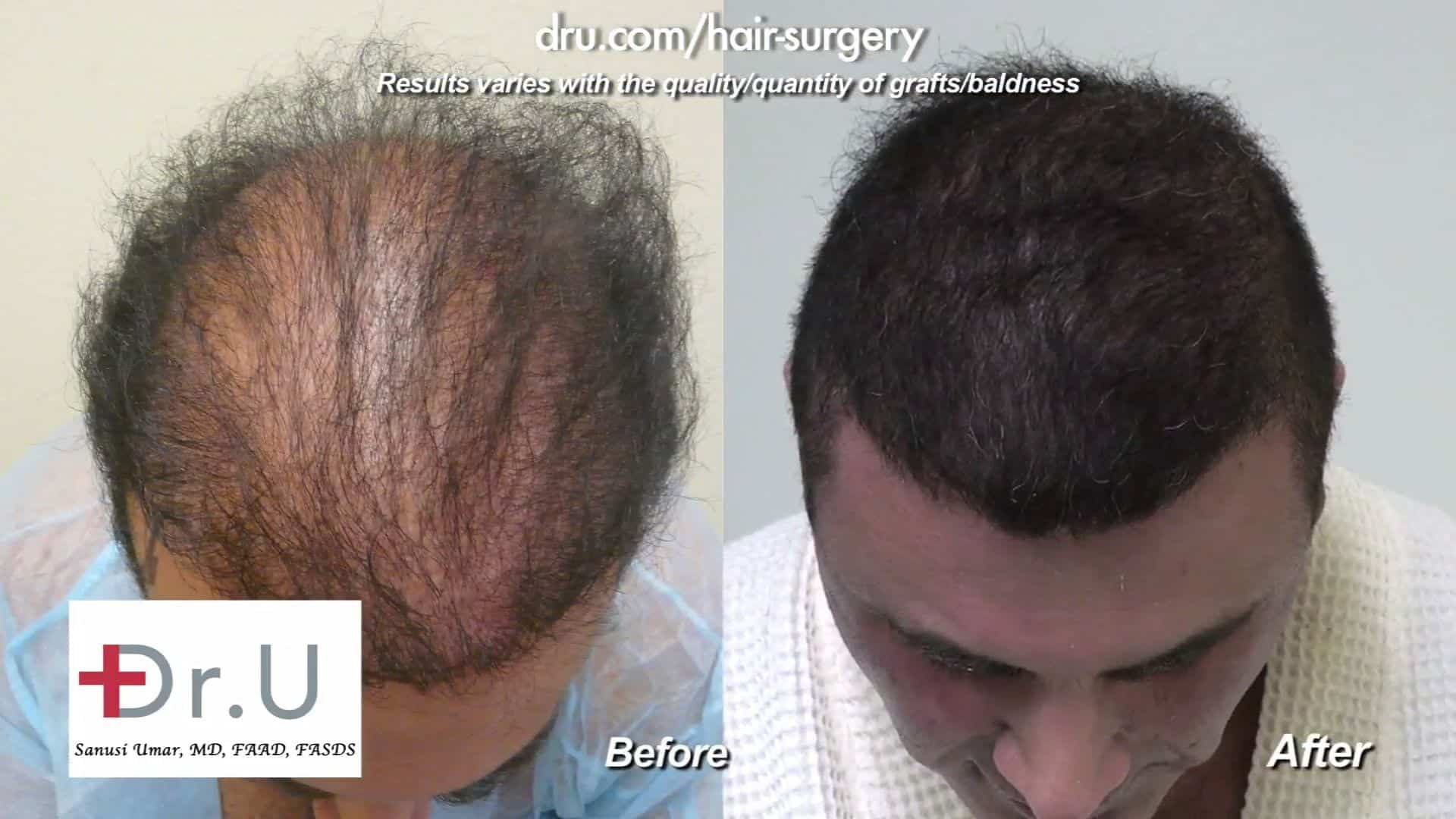 Video - Hair Transplant Using Beard Hair in Los Angeles