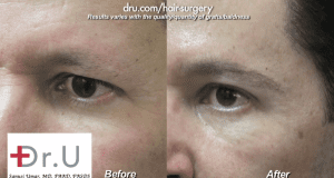 Side view of male eyebrow restoration using leg hair for donor grafts