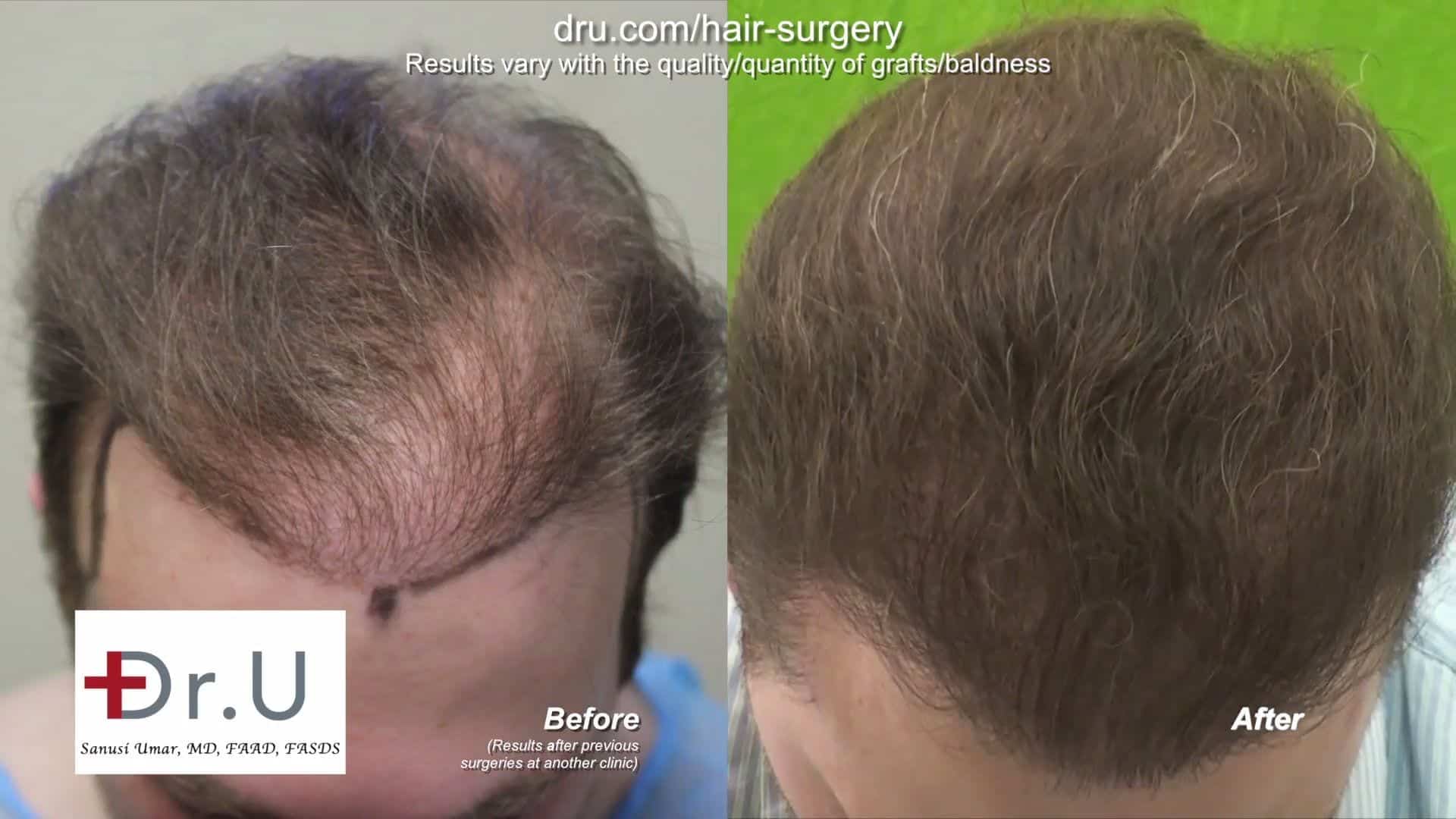 DrUGraft body hair FUE Restores donor depleted bald patient: Patient after treatment from Dr. Umar