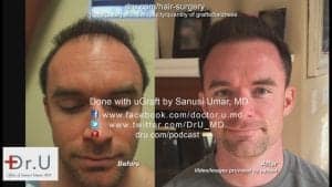 This patient is showing off the results of his hair transplant surgery by Dr. Umar in Los Angeles.