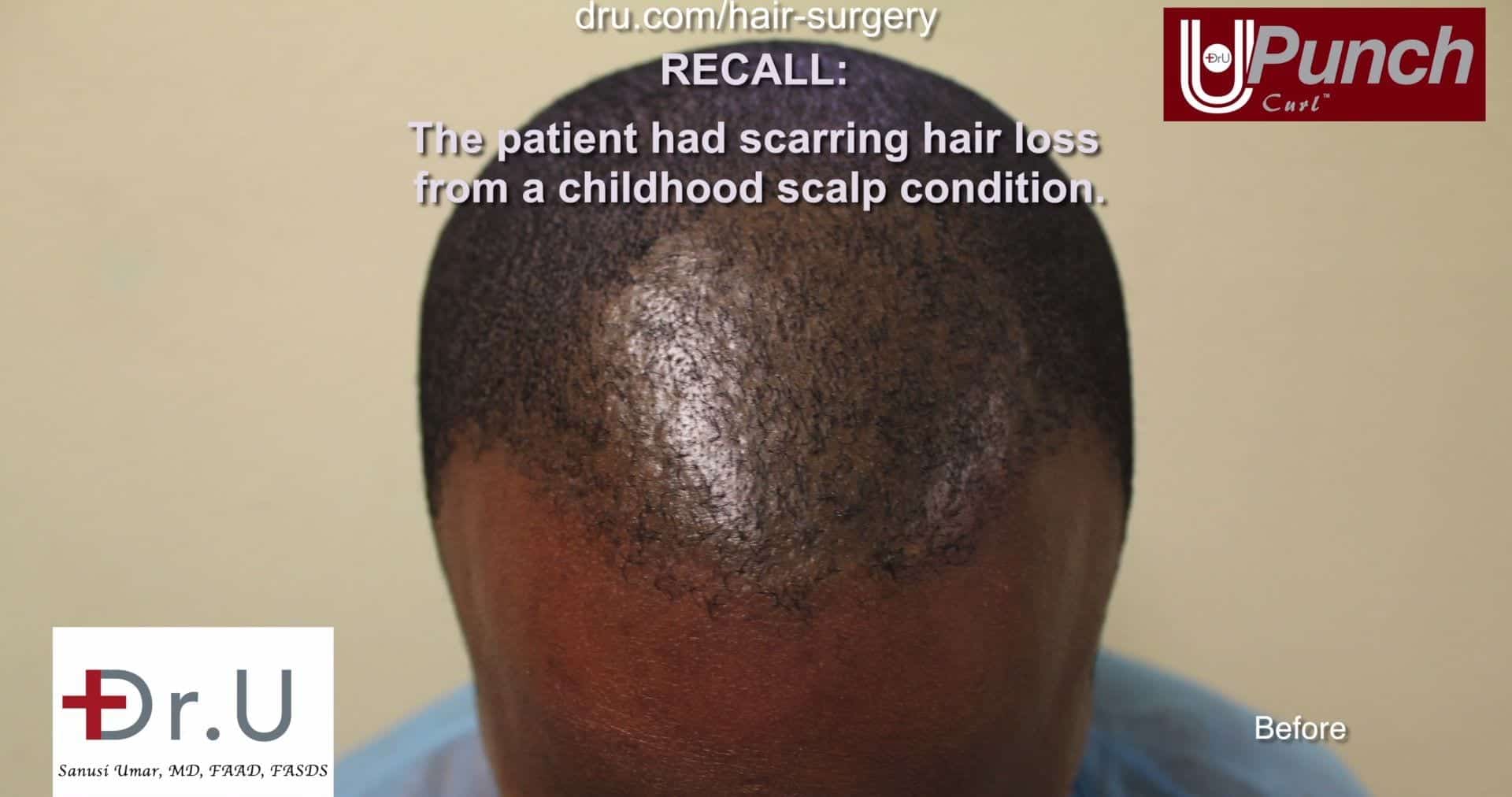 Video - BEST TOOL FOR FUE Hair Transplant for Black Men