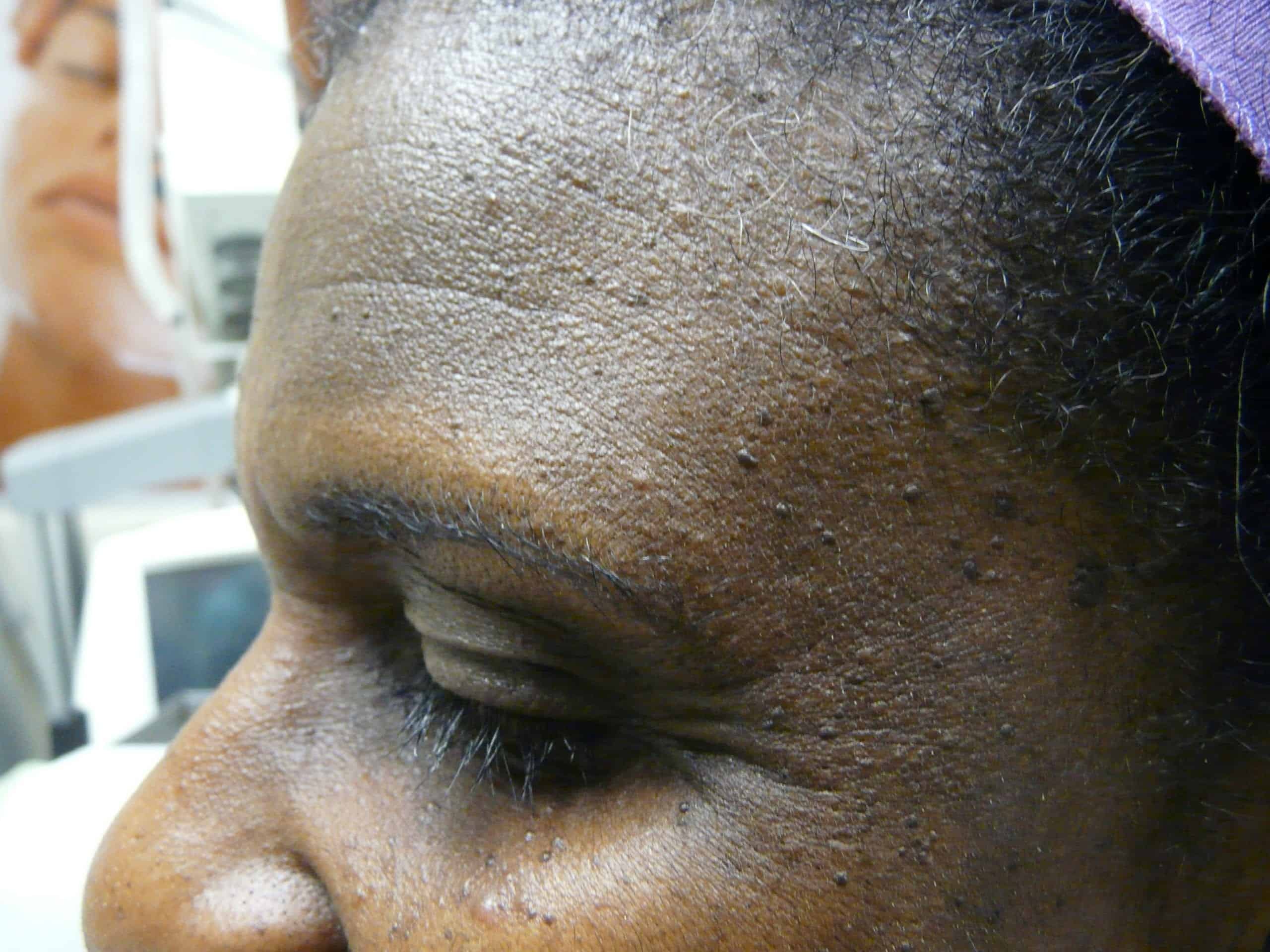 An example of DPN skin causes