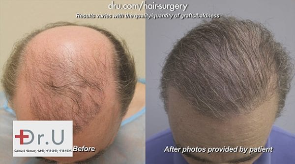 Depleted Donor Supply Rescue - UGraft Hair Transplant - 1-310-318-1500