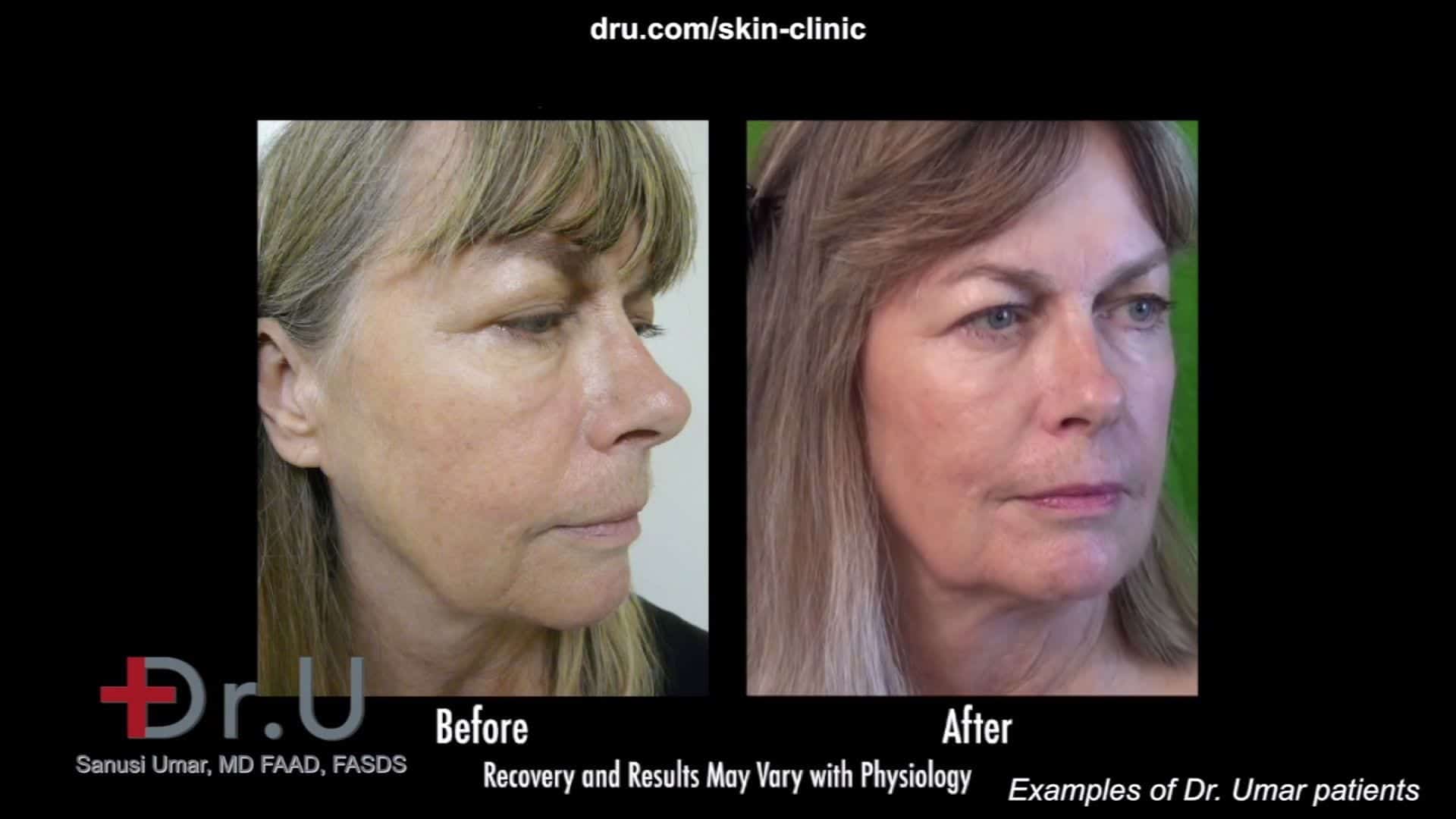 What are the benefits of a liquid facelift? - Facial Aesthetics, Cosmetic  Skin Clinic