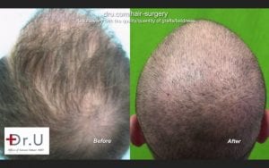 Hair graft quality is illustrated by the hair transplant growth yield experienced by patients *