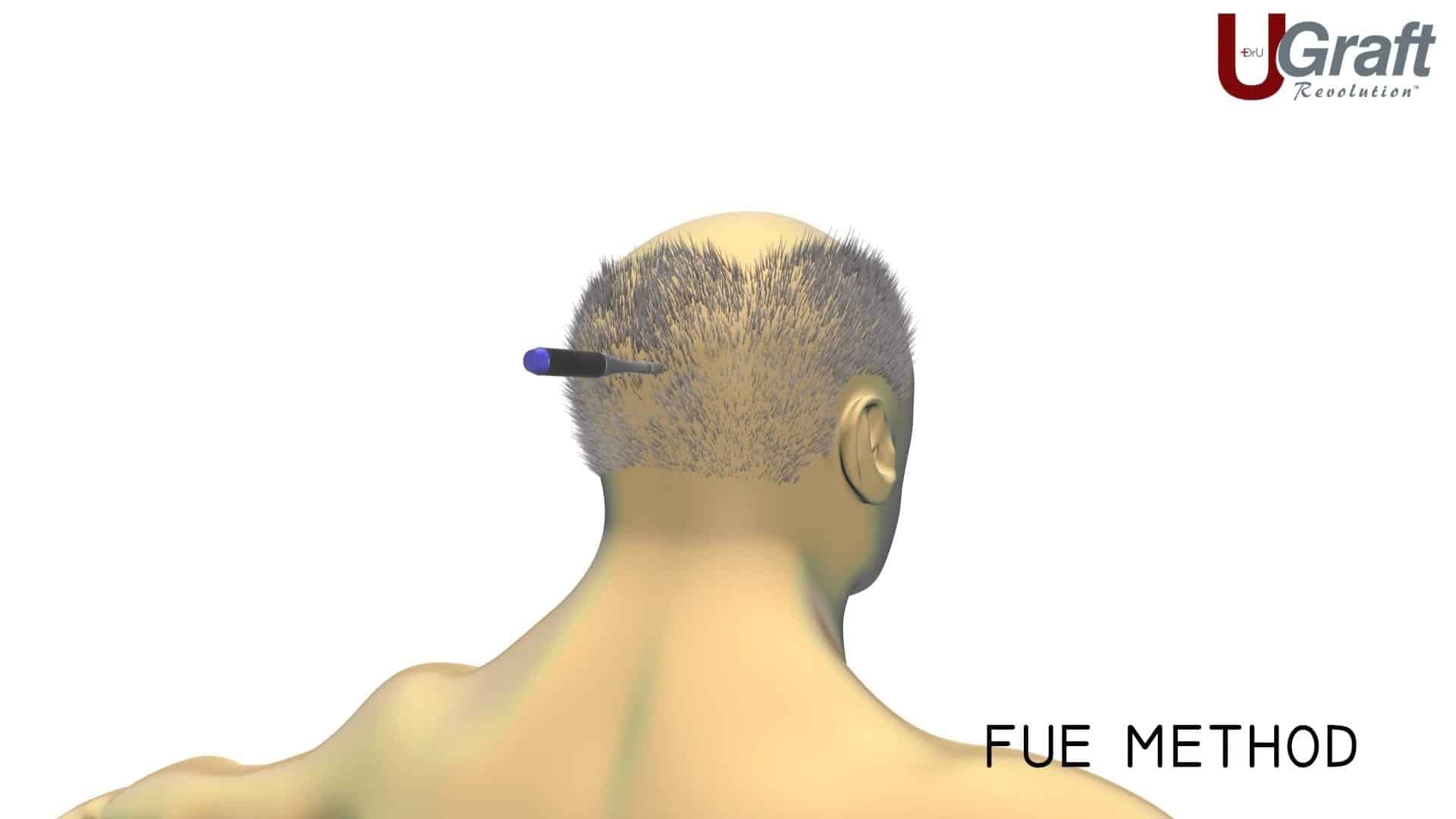 Dr. Umar deployed his advanced FUE method to extract 200 grafts from this patients head in order to fill in her temples. This photo shows how the FUE tool works to extract individual hair follicles to avoid any significant scarring.