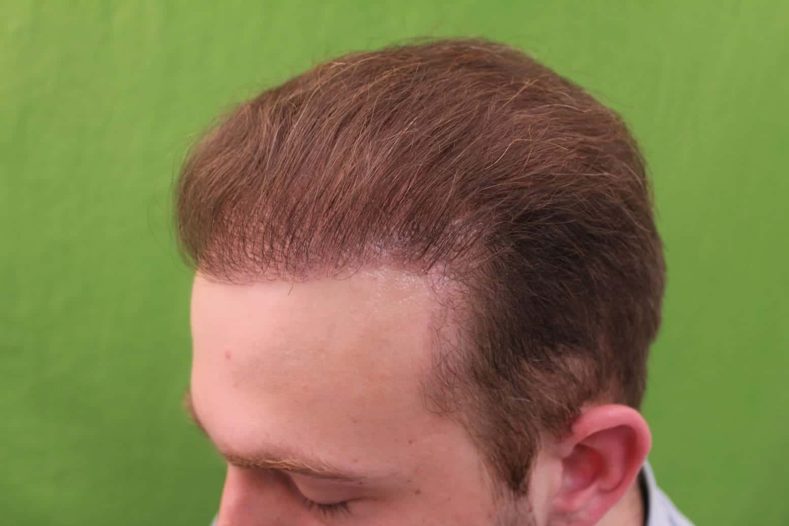 Hair Transplant Journey  Hair Transplant Result of Hairfree Hairgrow Clinic