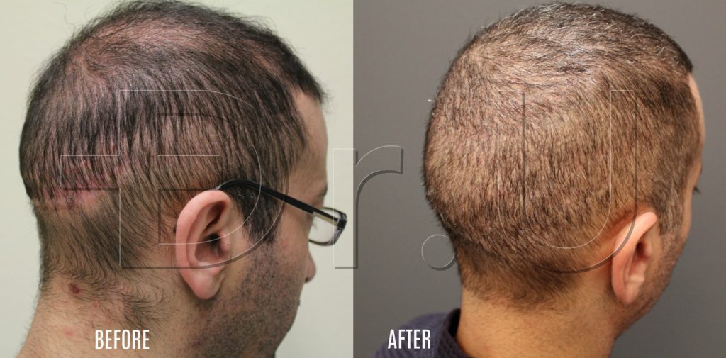 VIDEO: Hair Transplant Using Beard Hair Restores NW6 Hair Loss