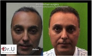 Full and natural hairline following Dr.UGraft FUE Corrective hair surgery*