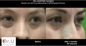 Three months after her lash enhancement procedure, the patient reached her goal to get longer eyelashes