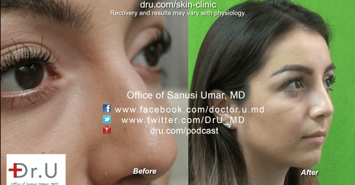 Video: Bump on the Nose Removal - Radiesse Injection by Dr. U