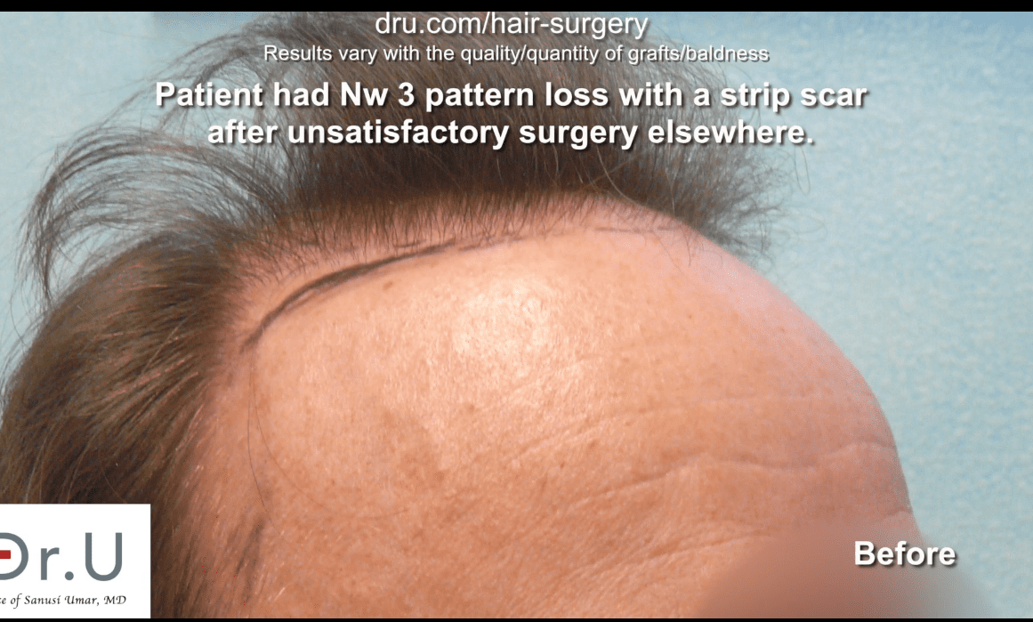 Video  Norwood 3 Crown Hair Loss and Strip Scar Treated by Dr U