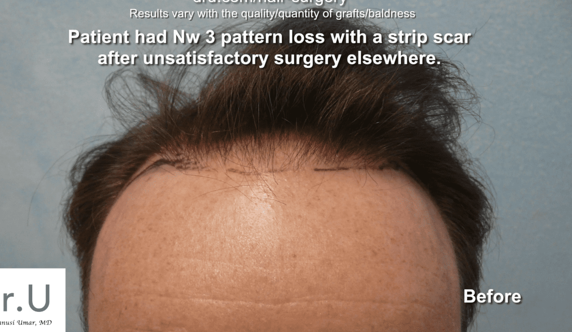 Video - Norwood 3 Crown Hair Loss and Strip Scar Treated by Dr. U