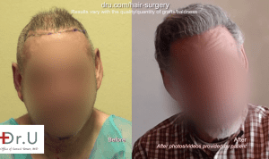 Unable to provide enough donor hair from his head, this patient used donor areas from his body in order to achieve the hair surgery correction best for him