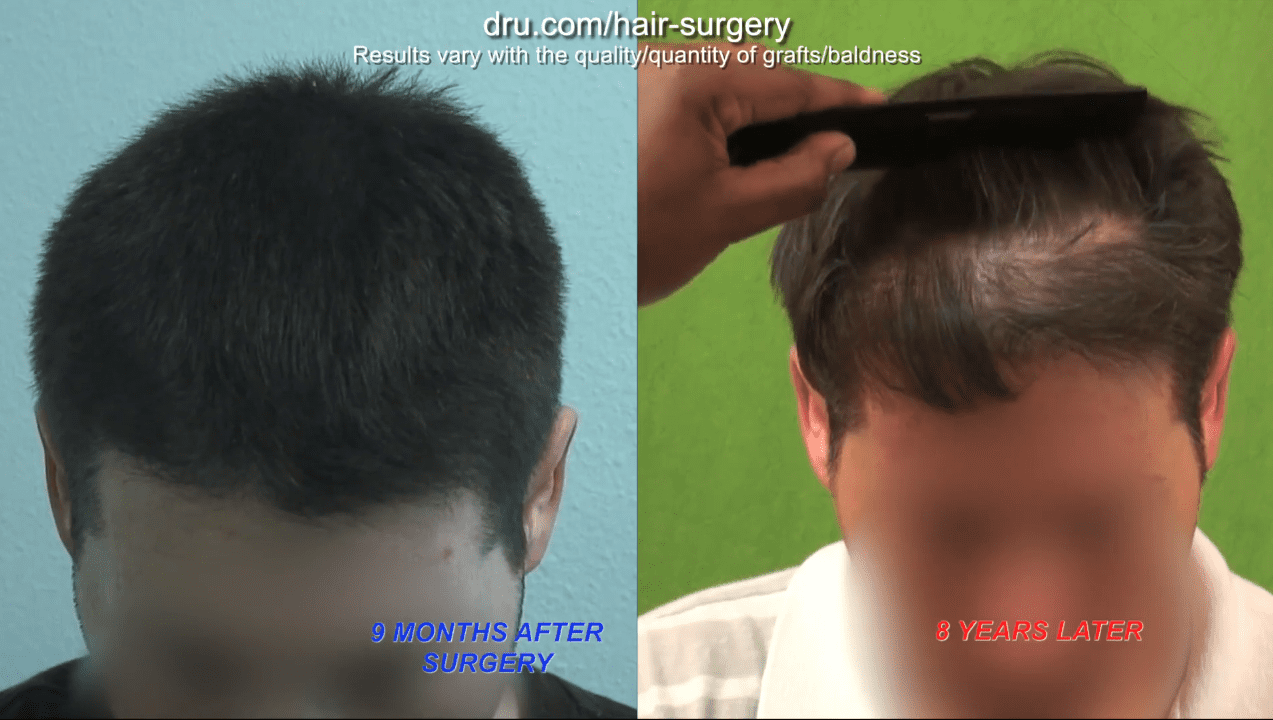 VIDEO: FUE Hairline Revision - Young Palos Verdes Patient 8 Years Later