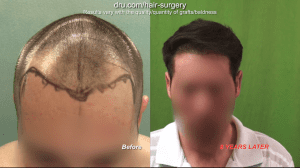 After receiving a hair transplant at a young age, another surgery is usually expected later on.