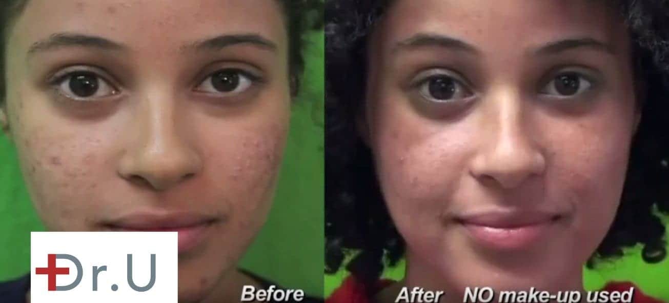 Fraxel Dual Laser Treatment for Acne Scars