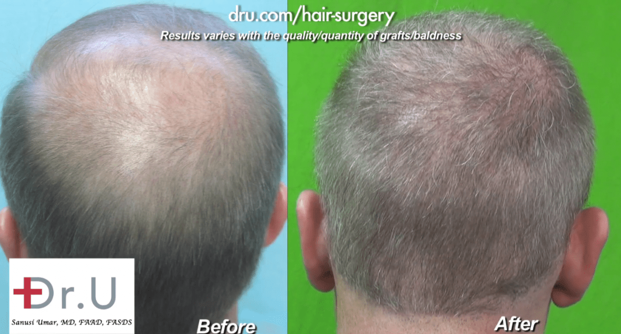 Video: Norwood 6 FUE before and after Body Hair Transplant by Dr. U