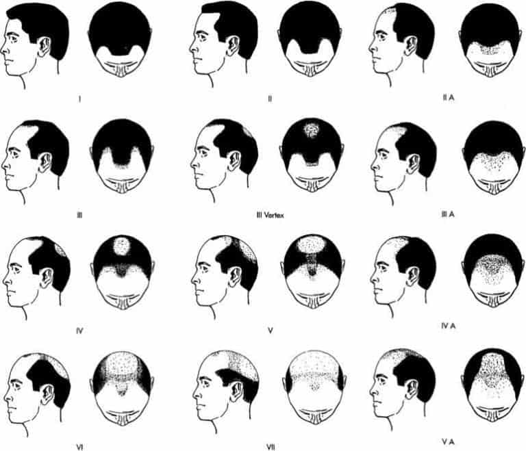 The Norwood scale of hair loss identifies typical patterns in hereditary hair loss. While the uGraft calculator can offer more accurate estimates according to donor source, hair texture, and skin tone, individuals can roughly approximate how many grafts needed for hair transplant using this classification. 